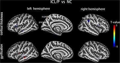 Anomalous cerebral morphology of pregnant women with cleft fetuses
